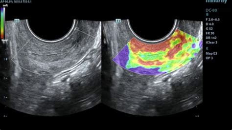 CERVIX ELASTOGRAPHY CERVICAL ELASTOGRAPHY YouTube