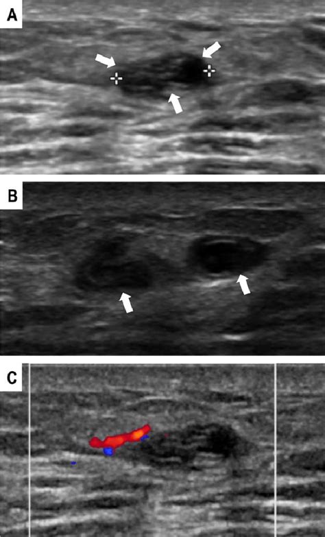 Sparganosis In A 52 Year Old Man With A Palpable Mass A And B Gray