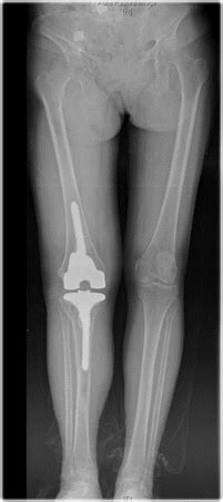 ACCK Revision Knee System JRI Orthopaedics