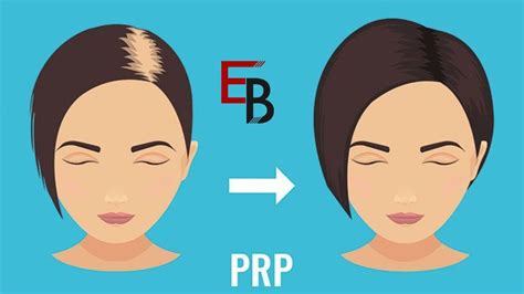 What Are The Different Types Of Hair PRP Treatments