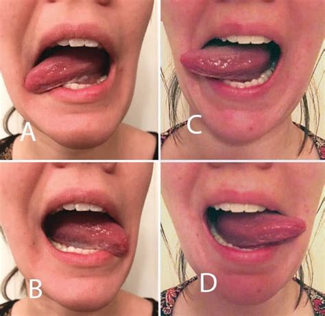 Labial Frenectomy Before And After