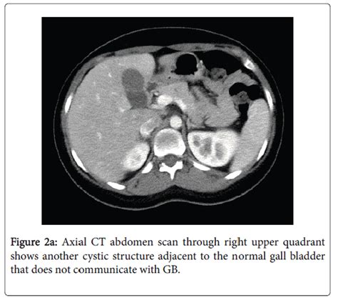 Radiology Cystic Structure