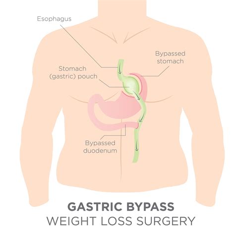 Bypass Ou Sleeve Qual A Melhor Técnica Cirurgia Bariátrica E