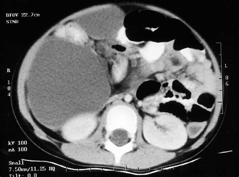 Abdominal Ct Scan Showing A Large Cystic Mass With Septa Displacing The