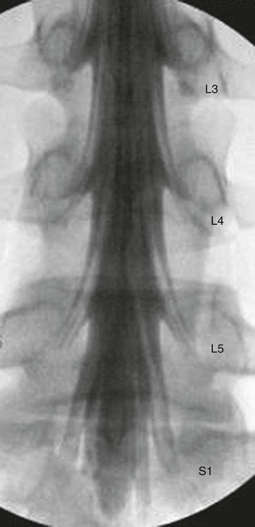 Selective Nerve Root Block | Radiology Key