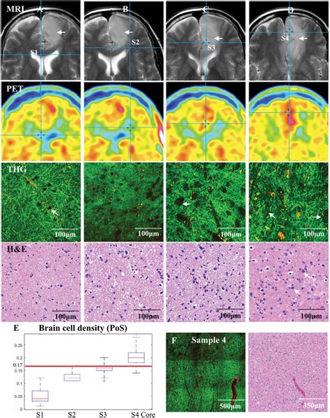 THG Imaging Of A Grade II Astrocytoma IDHmutant Colocated On