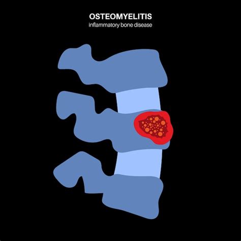 Osteomielitis Vertebral Secuestro Y Dolor De Los Huesos De La Columna