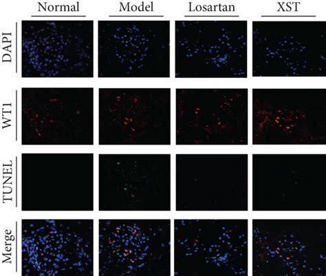 Effects Of Xst On Podocyte Morphological Changes And Podocyte Apoptosis