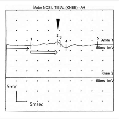 The Sural Nerve Biopsy Shows Large Number Of Onion Bulbs Arrows A