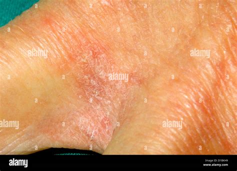 Scabies Rash On Hands