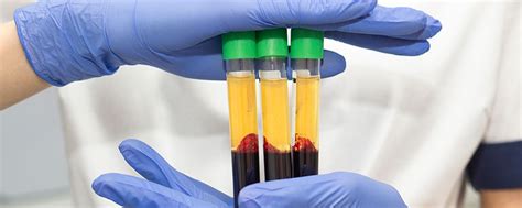 The Healing Power Of Platelet Rich Plasma Prp Therapy How It Works