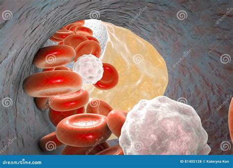 Atheroma Plaque Inside Artery Stock Illustration - Illustration of ...