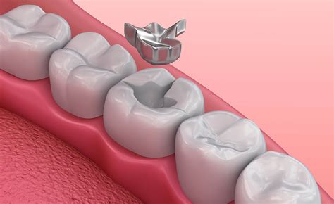 Amalgam Or Composite Fillings Pros And Cons Which Is Better