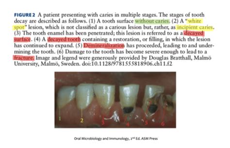 Chapter 22 Dental Caries Flashcards Quizlet