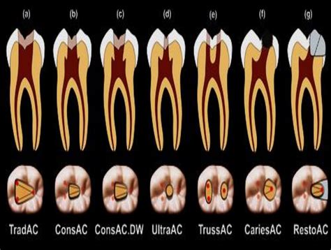 Classification Of Different Types Of Access Cavity Designs Of Posterior