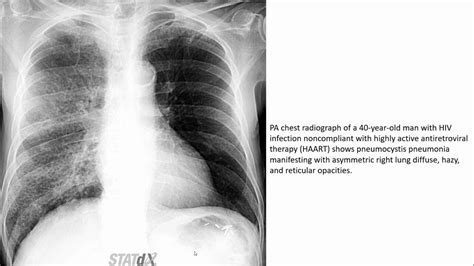 Pneumocystis Jirovecii Pneumonia Pjp Pneumocystis Pneumonia Pcp Imaging Youtube