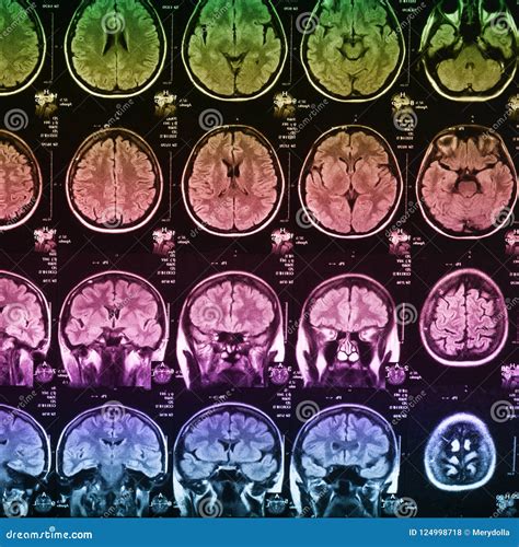 The X-ray of the Human Brain Stock Photo - Image of xray, radiology ...