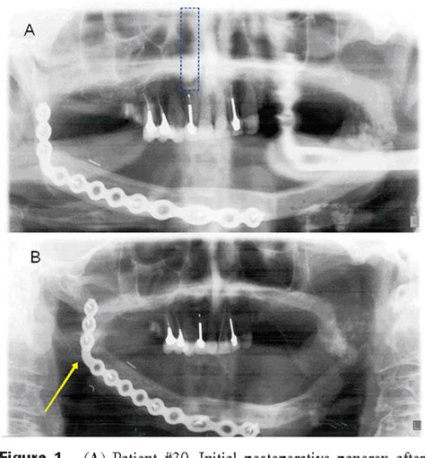 Table 1 From Disease Relapse After Segmental Resection And Free Flap