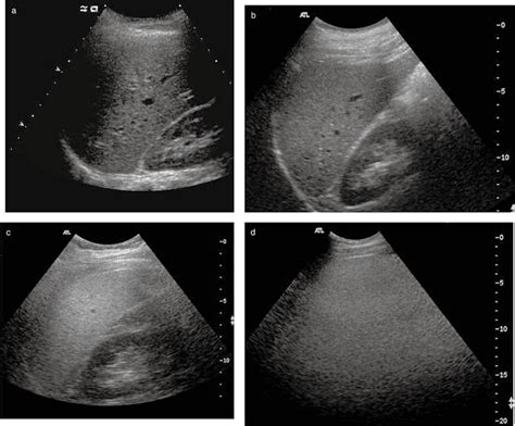 Abnormal Liver Ultrasound