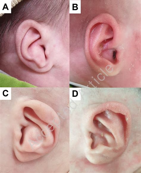 Figure 1 From Nonsurgical Correction Of Congenital Concha Cavum