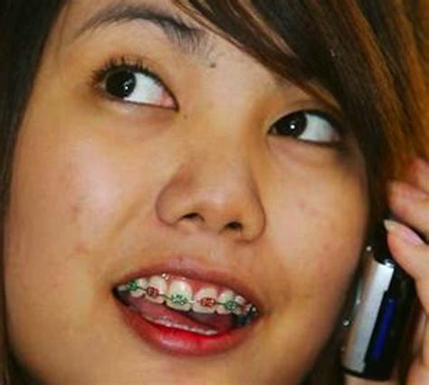 Braces Are New Trend In Asia 8 Pics