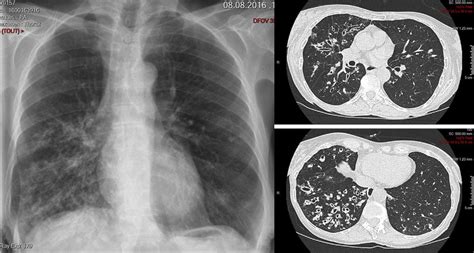 Chest X-ray and CT scan showing bronchiectasis with air-fluid levels ...