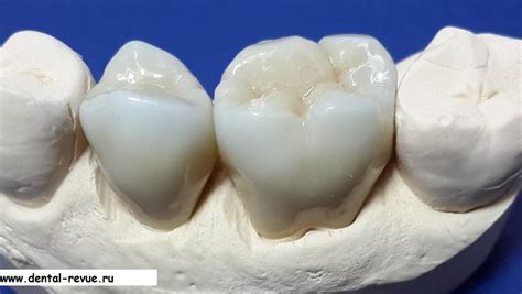 Dental-Revue | Фотогалерея | Клинический случай №42: цельноциркониевые ...
