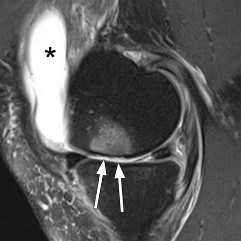 State Of The Art Imaging Of Osteoarthritis—revisited 2020 Radiology