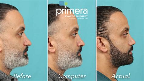 Predicting Rhinoplasty Results With Computer Imaging Primera Plastic