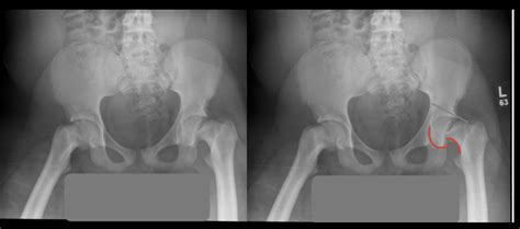 Slipped Capital Femoral Epiphysis X Ray