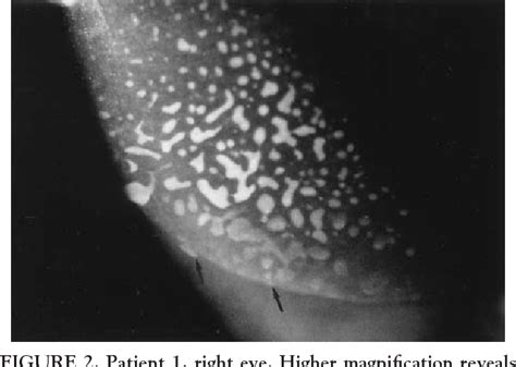 Figure 2 from Sloughing of corneal epithelium and wound healing ...