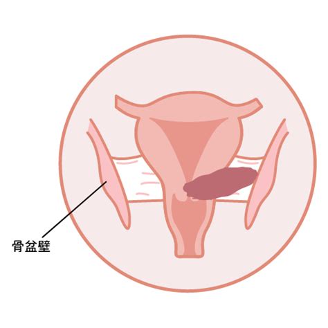 什麼是子宮頸癌？成因、症狀、治療一次看懂