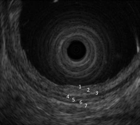 Seven Layer Structure Of The Normal Esophageal Wall Download