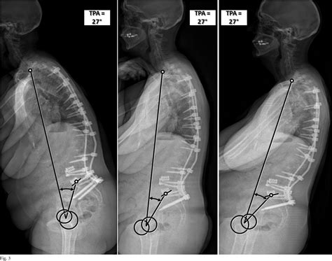 Figure 1 From TheT1 Pelvic Angle A Novel Radiographic Measure Of