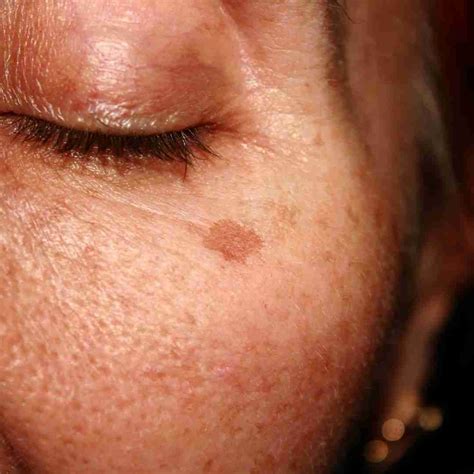 Brown Spot Removal Devonshire Dermatology London