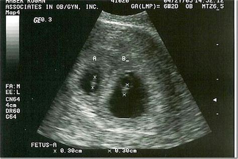 Ultrasound Pictures