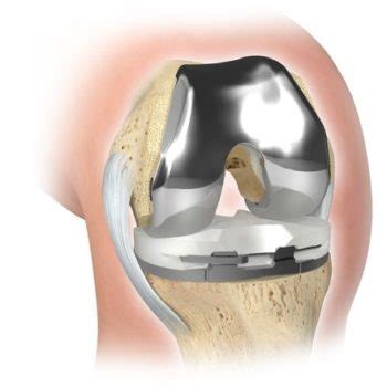 La Protesi Del Ginocchio Fisiosystem Centro Di Fisioterapia Vicenza