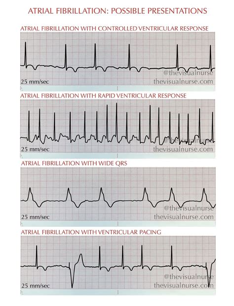 Atrial Fibrillation Vs Atrial Flutter On The Ecg For Nurses And Nursing