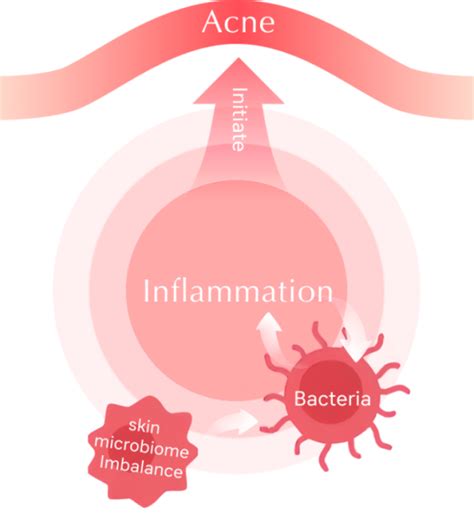 Bacterial Battles: How Microbes Fuel the Fire of Acne Inflammation | Voibon