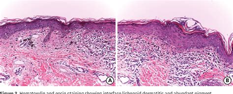 Figure 3 From Ribociclib Induced Erythema Dyschromicum Perstans Ashy