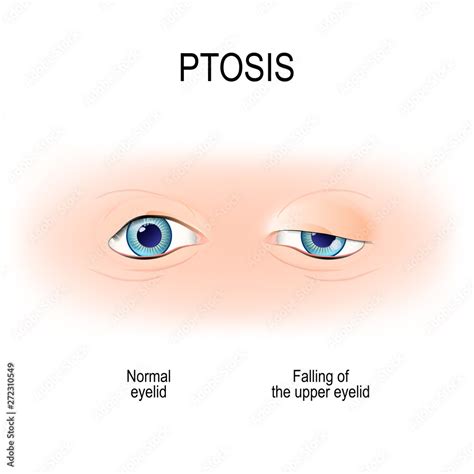 Ptosis is a drooping of the upper eyelid. lazy eye Stock Vector | Adobe ...