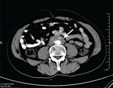 Retroperitoneal Fibrosis The Operative Review Of Surgery