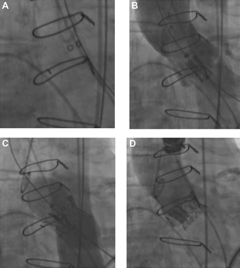 Transcatheter Heart Valve Implantation For Failing Surgical