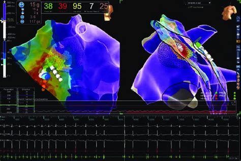 Epicardial Interruption During Rf Of The Clinical Tachycardia Ablation Download Scientific