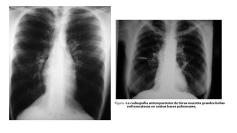 Enfisema Pulmonar