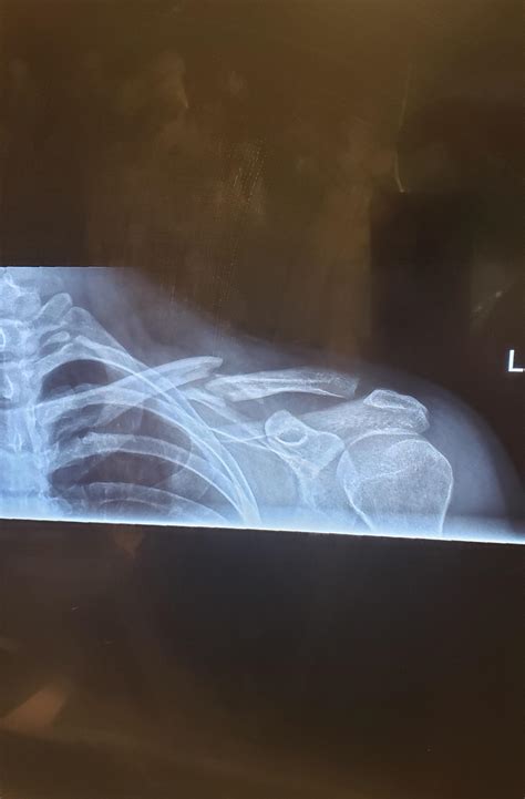 Broke my collarbone on my longboard : r/XRayPorn