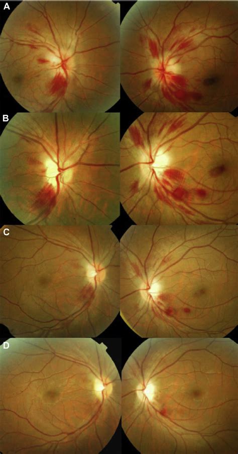 A Bilateral Disc Edema With Flame Shaped Hemorrhages Was Found At The Download Scientific