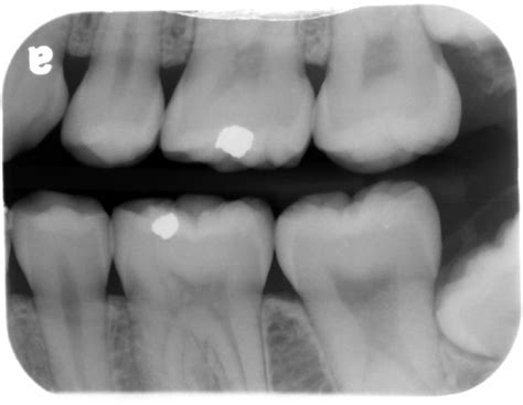 Case of the Week: Taurodontism – Dr. G's Toothpix