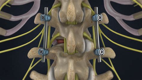 ALIF | Anterior Lumbar Interbody Fusion (ALIF) | ALIF Surgery Melbourne