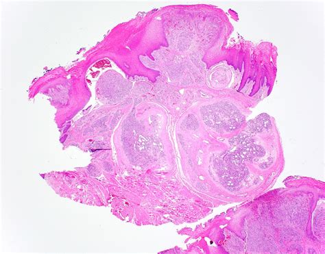 Pyogenic Granuloma Lips Pathology Outlines